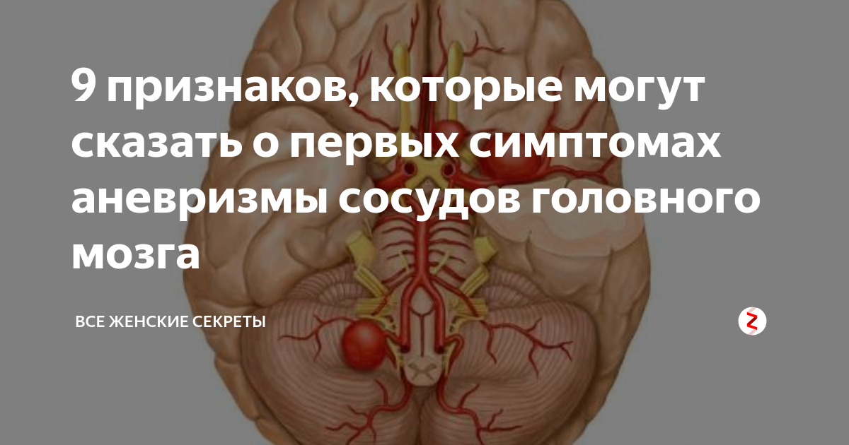 Аневризма в голове симптомы. Что такое аневризма головного мозга симптомы и последствия. Симптомы при аневризме головного мозга. Аневризма головного мозга фото. Локализация аневризм головного мозга.