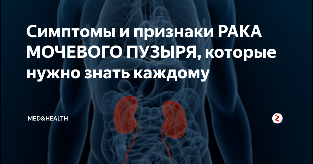 Опухоль мочевого пузыря симптомы. Опухоль мочевого пузыря у мужчин симптомы. Симптомы онкологии мочевого пузыря. Онкологическое заболевание мочевого пузыря.