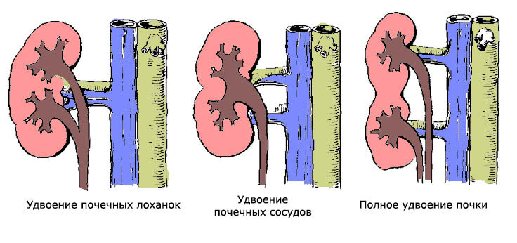 Рак почечной лоханки и мочеточника