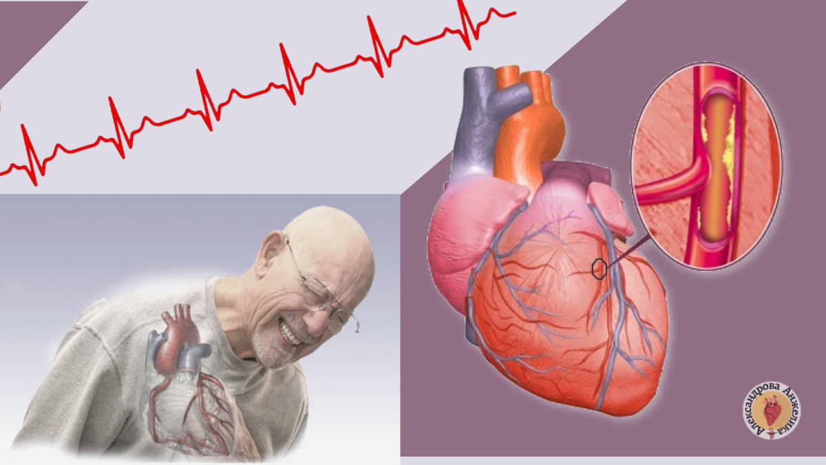Симптомы ишемической болезни сердца у мужчин