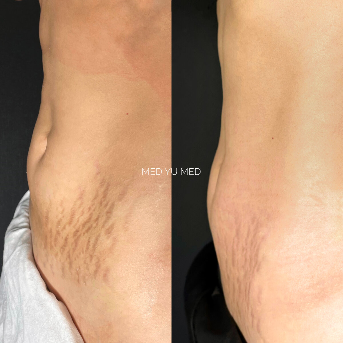 Фото до и после процедуры RF-лифтинга в клинике эстетической косметологии MED YU MED.