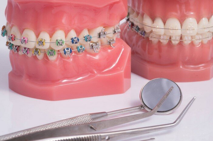 «Хочу поставить брекеты. Какие лучше выбрать?» | Стоматология ROOTT | Дзен