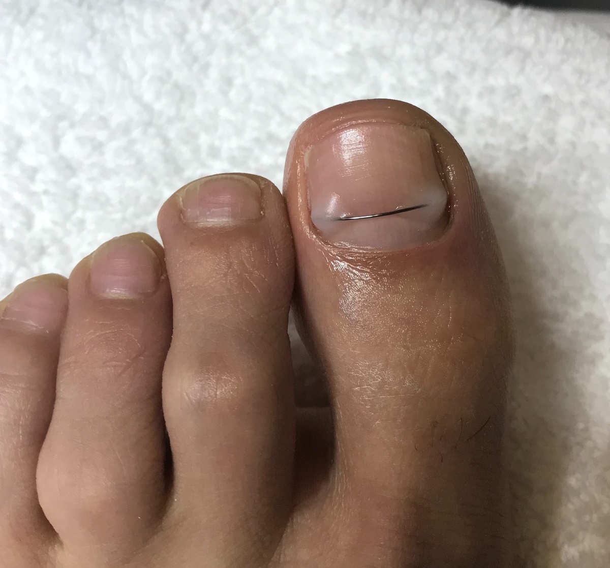 Коррекционная система безболезненно корректирует врастающий ноготь