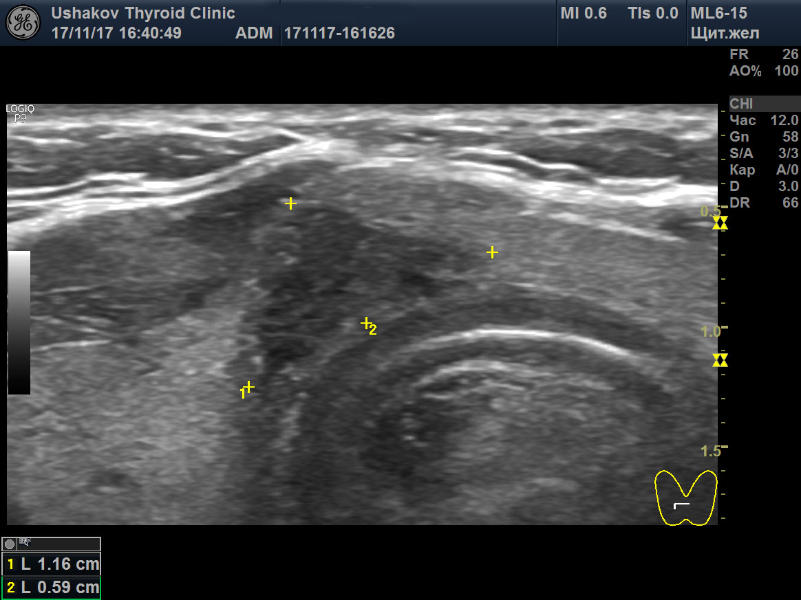 Узлы перешейка. Медуллярная опухоль щитовидной железы УЗИ. Анэхогенный узел щитовидной железы. Кальцинат щитовидной железы УЗИ. Узел перешейка щитовидной железы УЗИ.