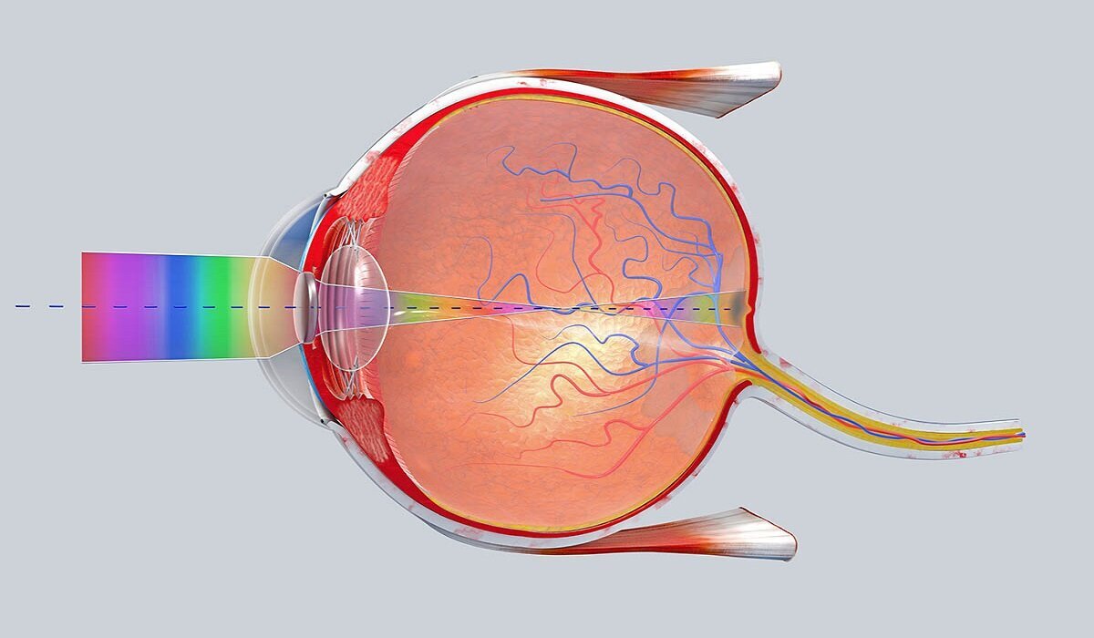 Тотальная отслойка сетчатки. Глаукома отслойка сетчатки. Отслойка сетчатки офтальмоскопия.