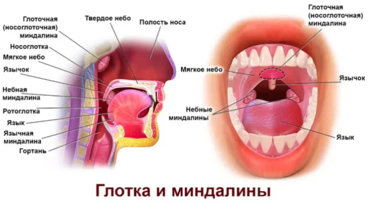 Диагноз - аденоиды. Хронический тонзиллит у ребенка