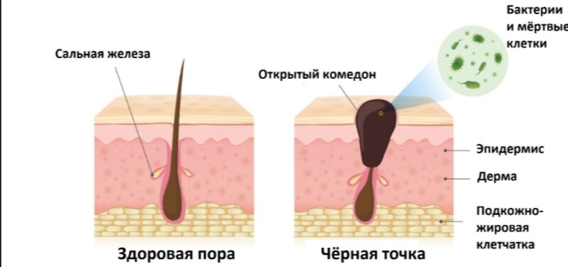 В точку: как бороться с черными точками на лице. Инструкция