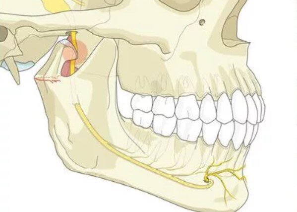 Почему развиваются осложнения после удаления зубов мудрости ...