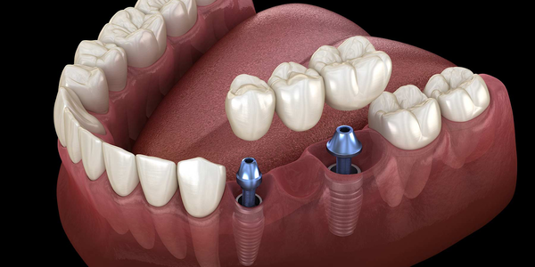 Ce trebuie să știți despre implanturile dentare înainte de a vă decide