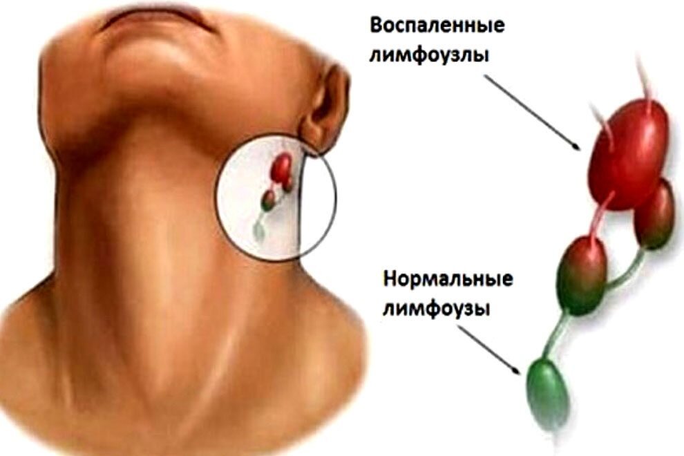 Как лечить узлы