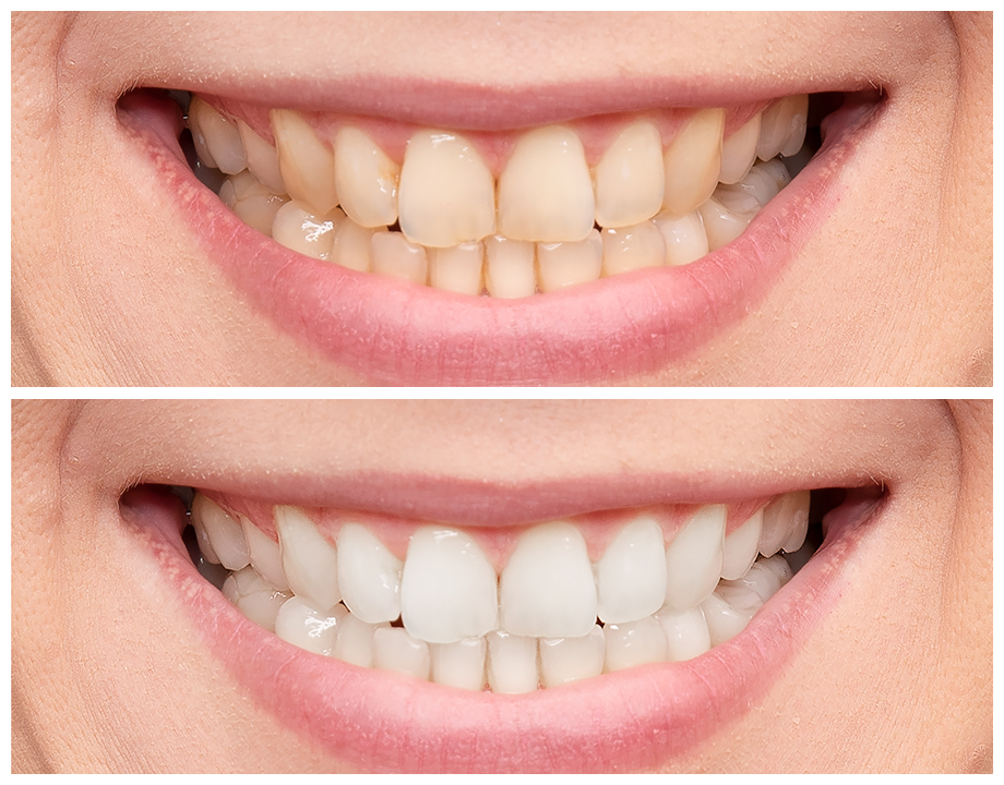 Полоски для отбеливания зубов crest 3d white. Oral pro отбеливающие полоски. Отбеливающие пластины для зубов. Можно ли отбеливать зубы полосками. Зубные полоски отбеливающие.