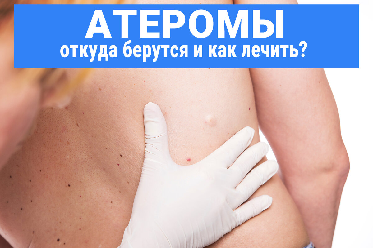 Как выглядит атерома на ноге Атерома На Узи Как Выглядит Фото Фото