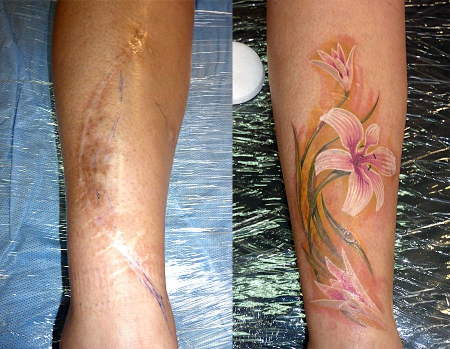 20 татуировок поверх шрамов и ожогов, которые помогли людям превратить их изъяны в изюминку