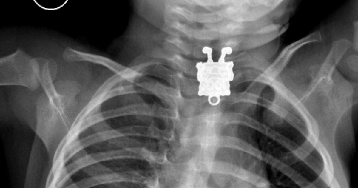 Рентген ребенку можно. Инородные тела пищевода рентгенограммы. Инородное тело гортани рентген. Инородное тело в дыхательных путях у ребенка рентген. Инородное тело пищевода рентгеноскопия.