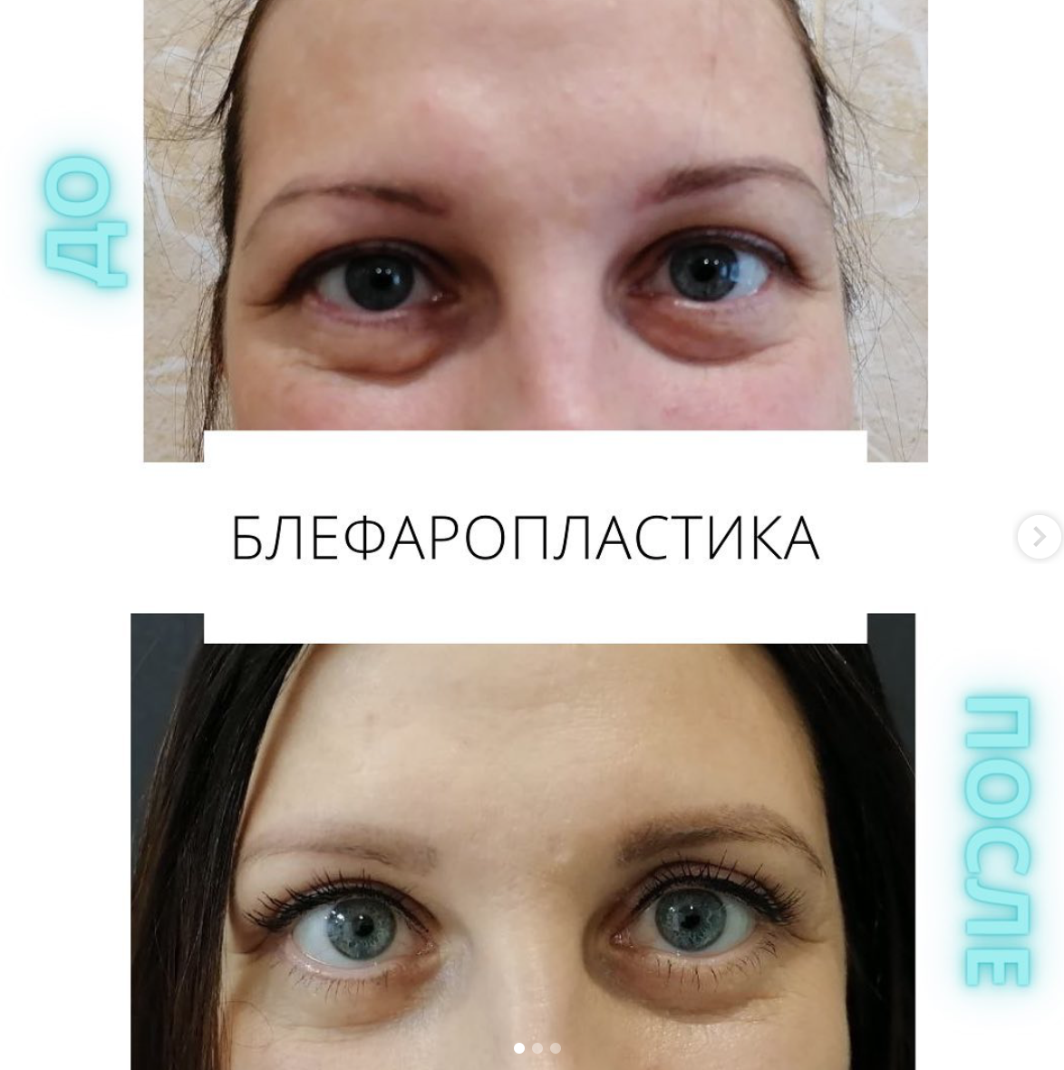 Реальное фото моей пациентки. Удаление нависающего века