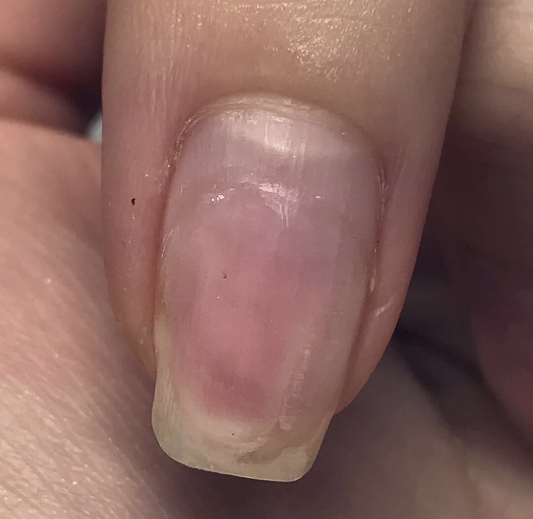Вмятина на ногте большого пальца: причины, диагностика и лечение