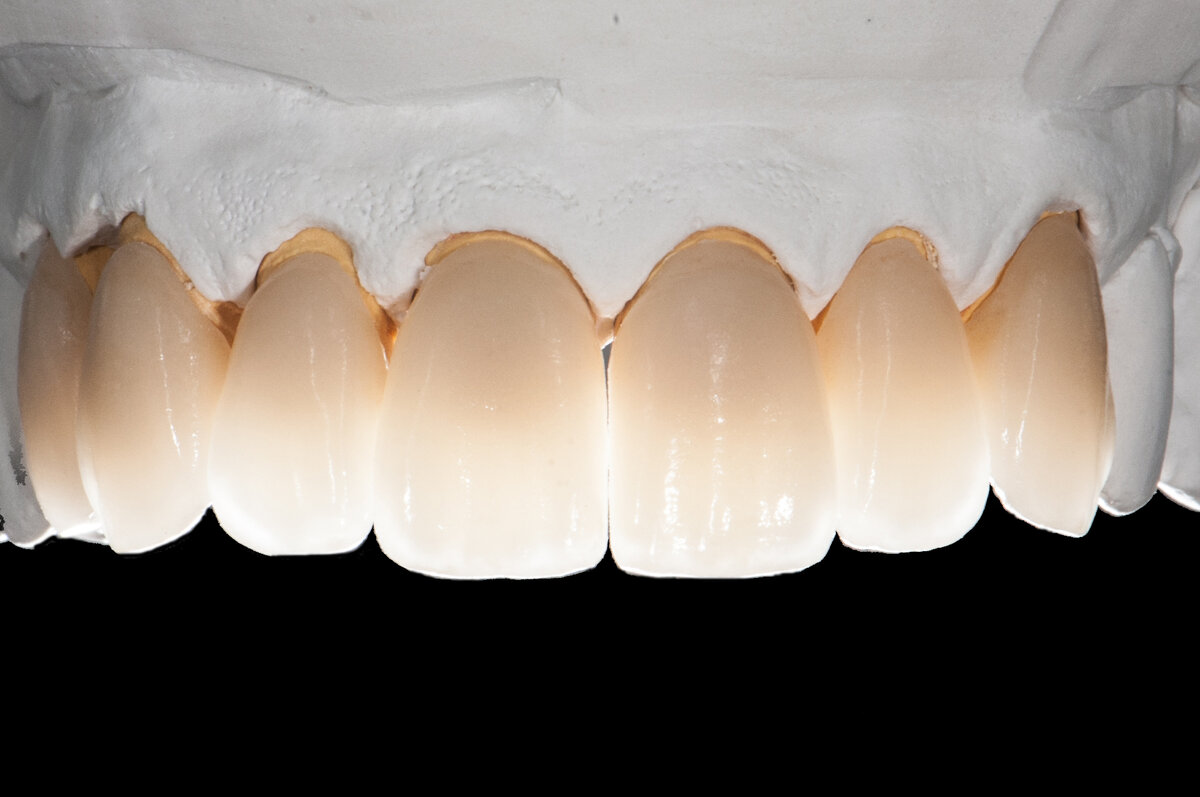 Кривые зубы и решение этой проблемы