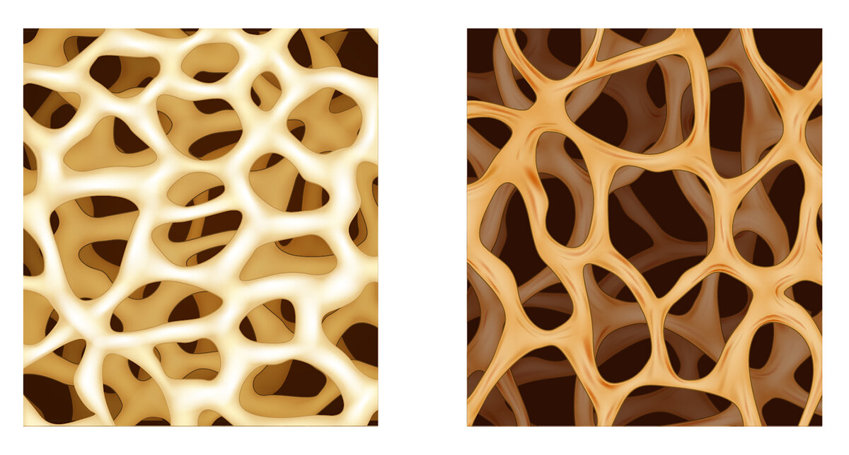 Нормальная кость и остеопороз