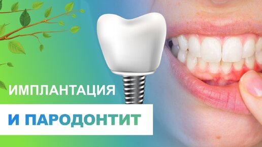 😬​ Имплантация и пародонтит