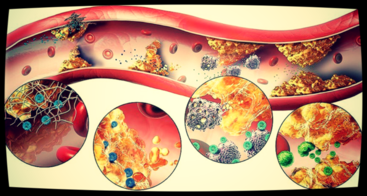 Страшно не само отложение, а отложение в местах повреждения сосудов, в местах воспалений.