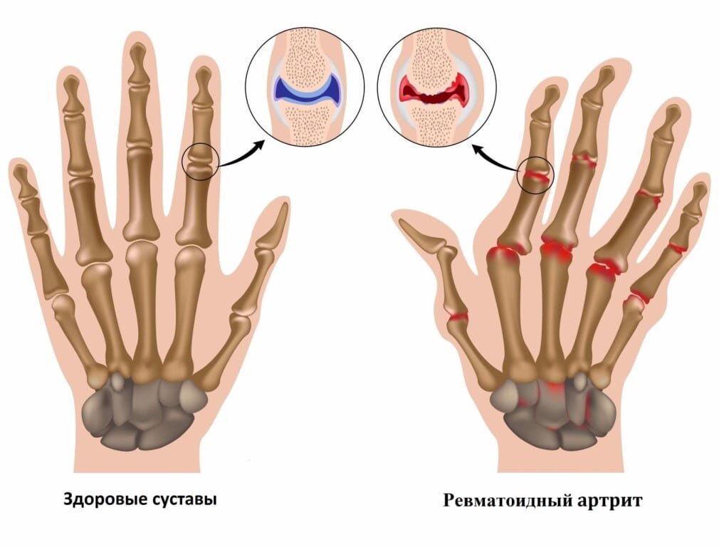 Лечение суставов народными средствами. Лечение желатином