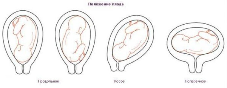 Тазовые предлежания плода: виды и биомеханизм родов, как определить