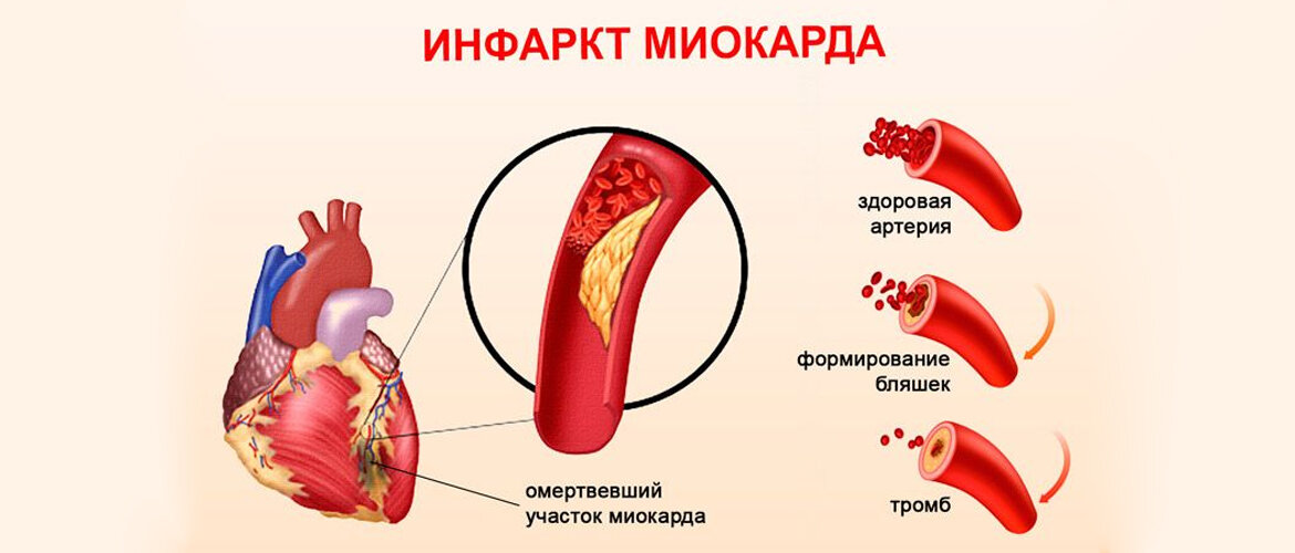 Инфаркт миокарда: причины возникновения, диагностика, лечение