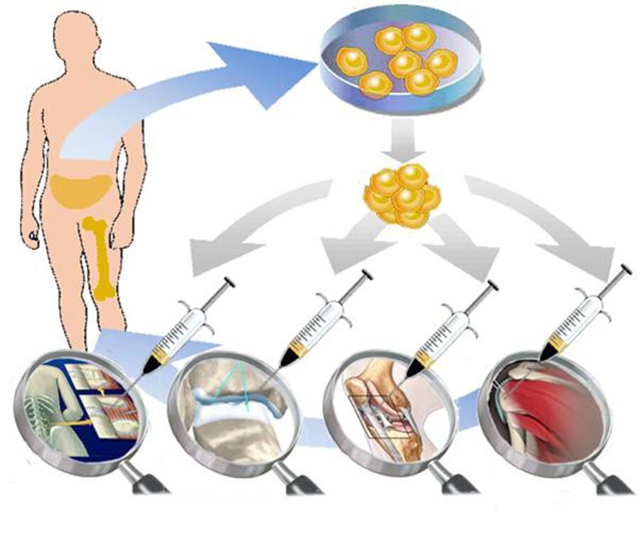 Инъекции стволовых клеток. Стволовые клетки жировой ткани. Мезенхимальные стволовые клетки жировой ткани. Дифференцировка стволовых клеток костного мозга. Стволовая стромальная клетка.