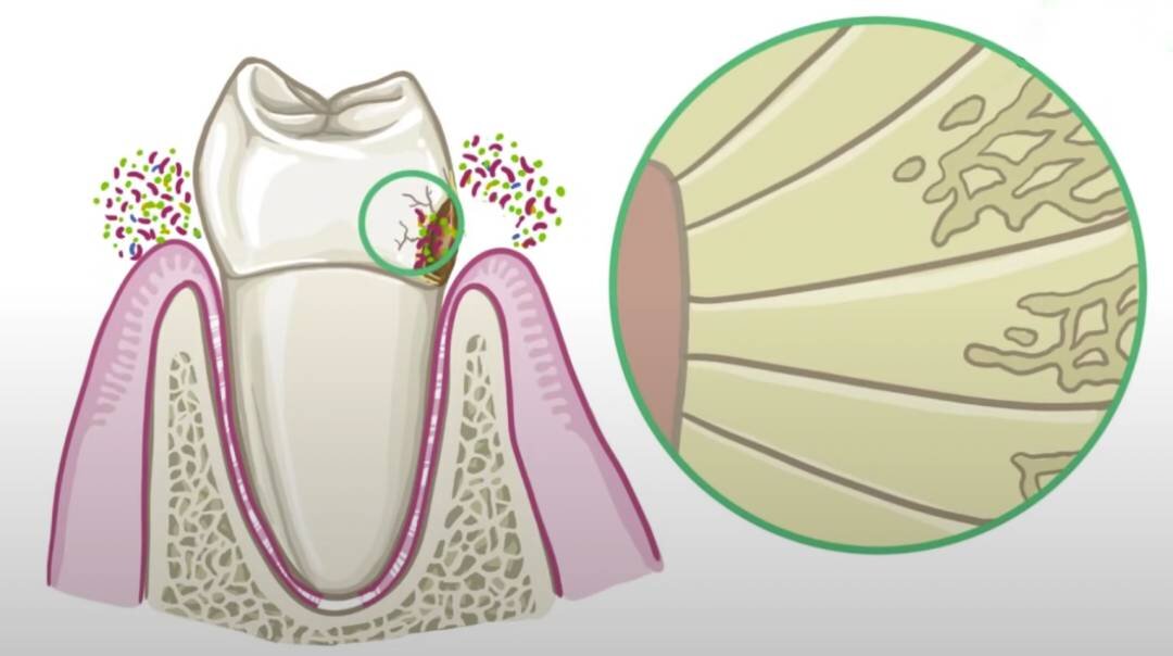 Бактерии разрушают дентин (увеличен), начинается кариес.
