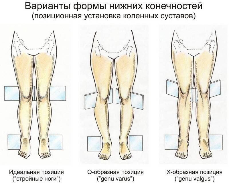 Виды деформации коленей