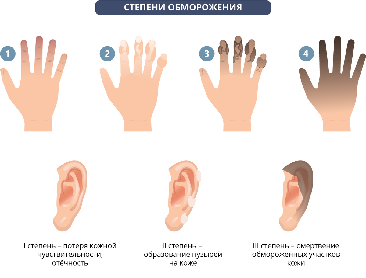 Обморожение