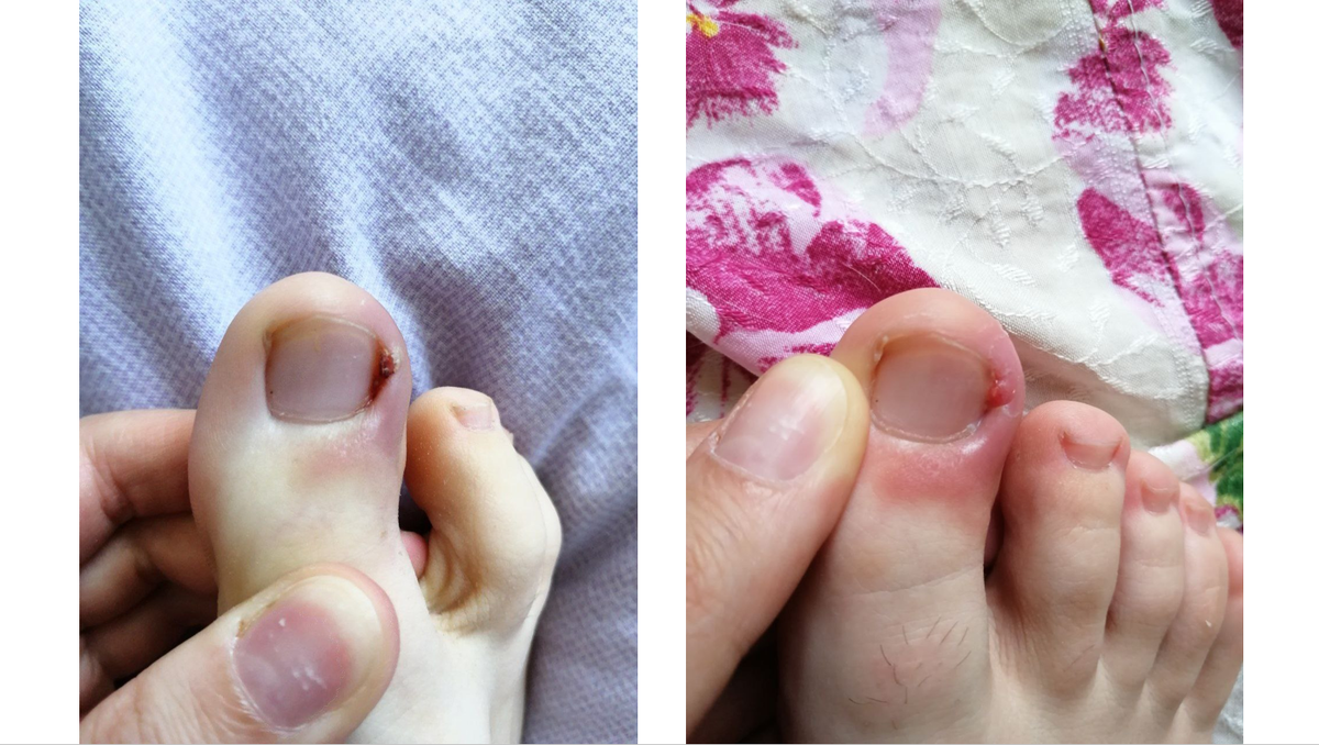 Фото (1). Опухший красный палец (август 2020 г.)
1. засохшая гнойная рана, 2. обработанная хлоргексидином гнойная рана