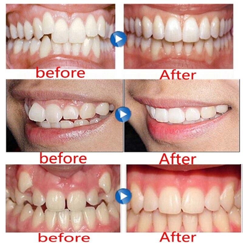 Зубные скобы