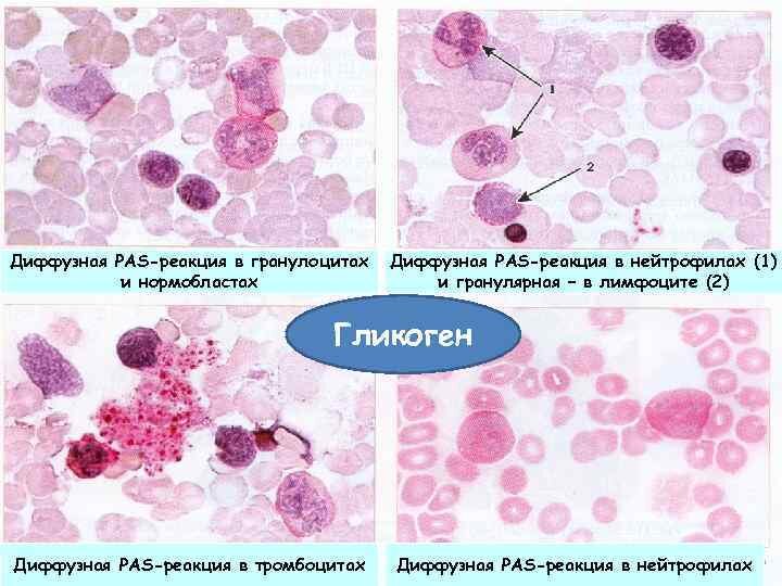 Гранулярная PAS- при ОЛЛ