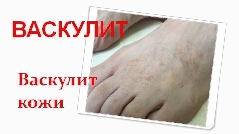 Васкулиты, ангииты кожи. Что это такое?