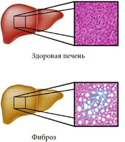 Фиброза капсулы. Перицеллюлярный фиброз. Очаговый фиброз печени. Перивенулярный фиброз печени.