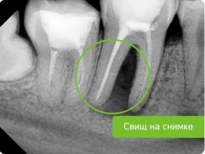 Неудачное лечение корневых каналов