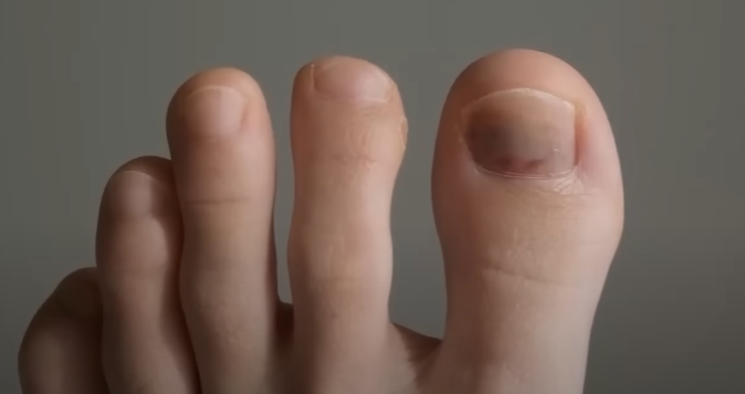 Грибок на ногтях – причины, профилактика, лечение