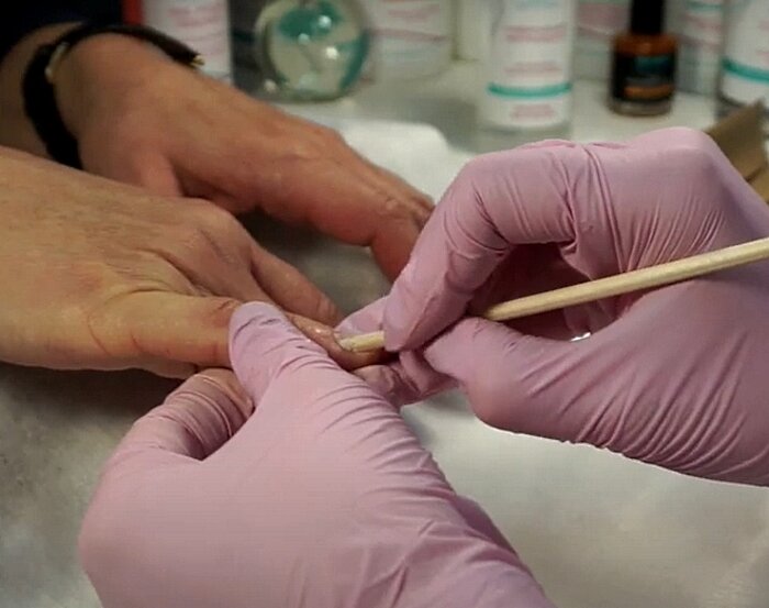 Удаление птеригия