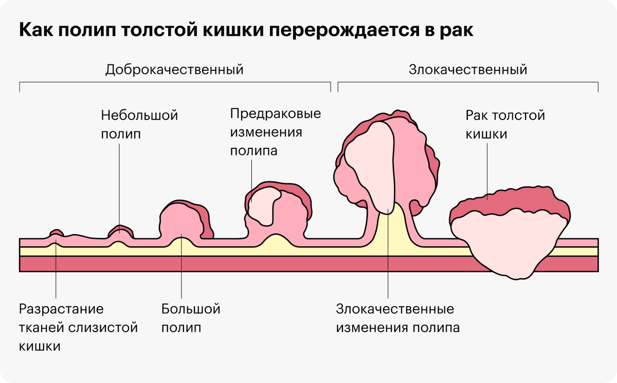Полипы толстой кишки колоноскопия. Гастроскопия и колоноскопия. Вредно ли для здоровья делать колоноскопию.