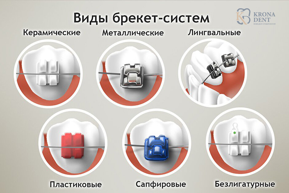 Виды брекетов
