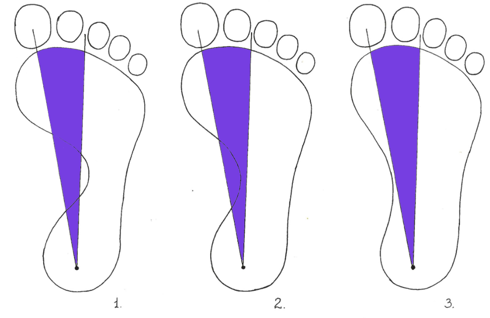 2 степень плоскостопия что делать. 2 Степень плоскостопия стопа. Отпечаток ноги с плоскостопием 3 степени. Начальная стадия плоскостопия у малыша.