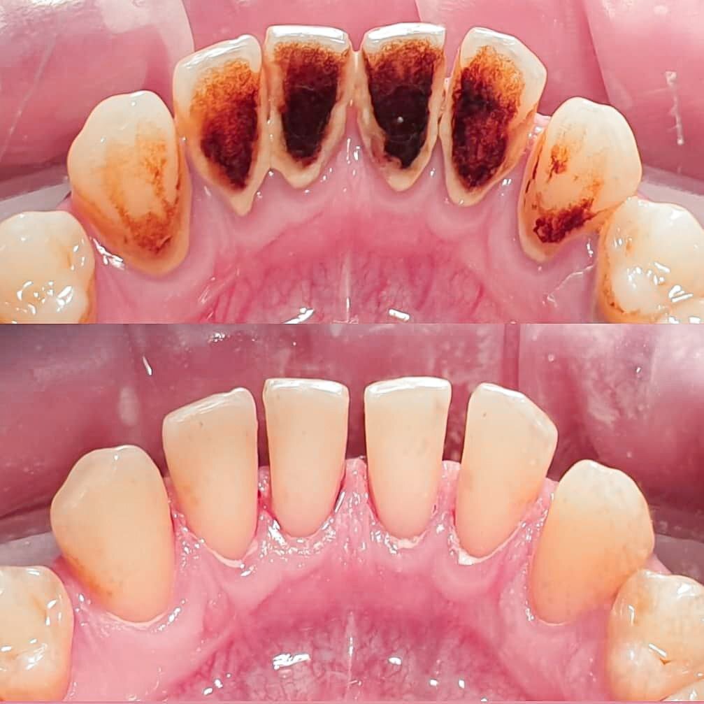 Качественно удалить скопившиеся отложения можно при помощи профессиональной гигиены полости рта. Посмотрите, какого результата можно добиться! 