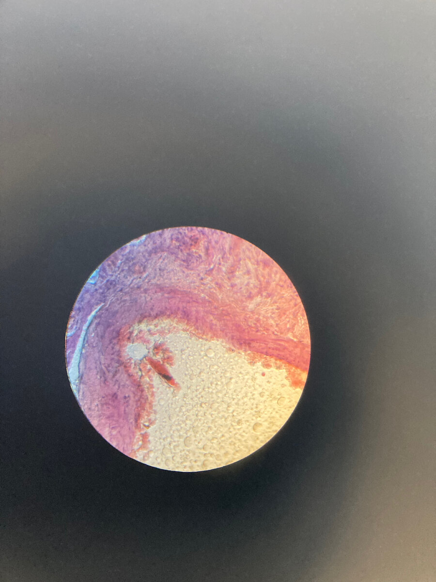 Бронх при приступе бронхиальной астмы. Фото из личного архива