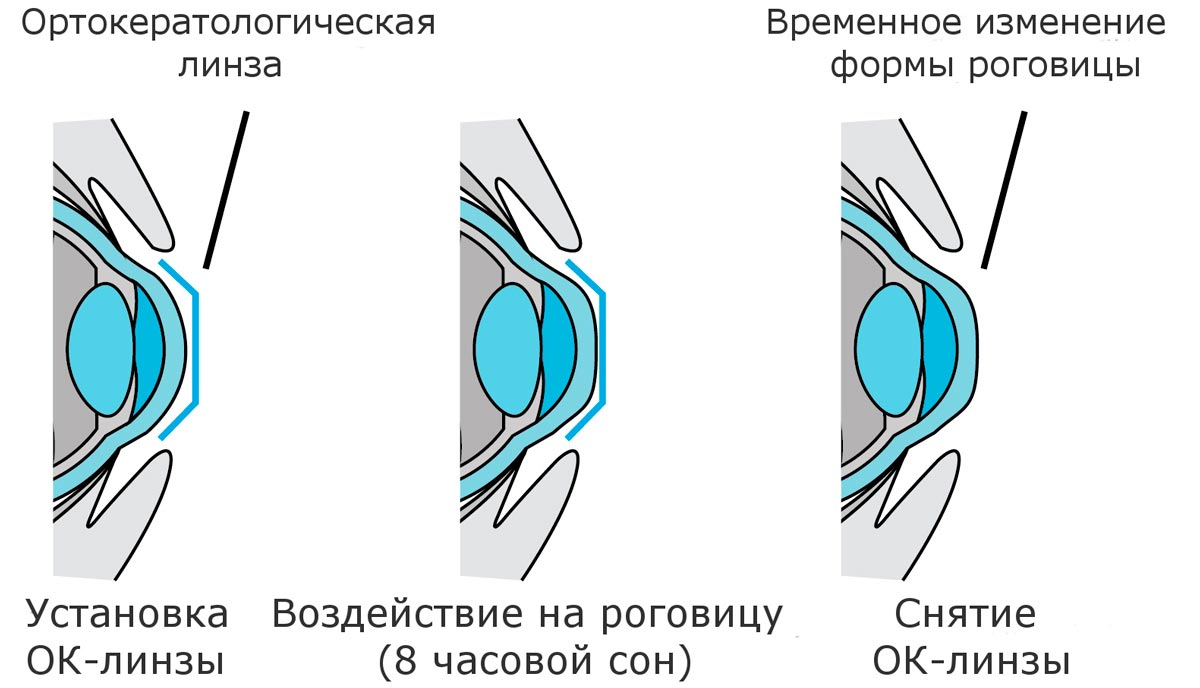 Ортокератология это. Принцип работы ночных линз. Как работают ортокератологические линзы. Ночные жесткие линзы для восстановления зрения. Ночные контактные линзы для коррекции зрения для детей.