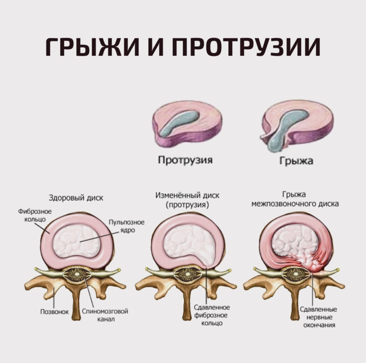 Протрузии и грыжи. Что нельзя?