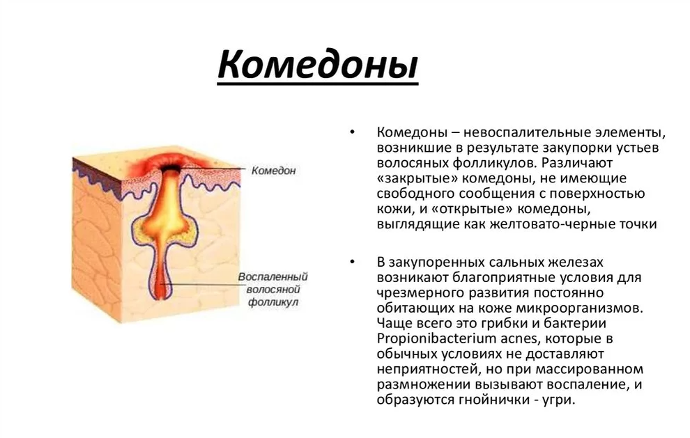 Отчего закрытый. Комедоны схема волосяной фолликул. Открытые и закрытые комедоны.