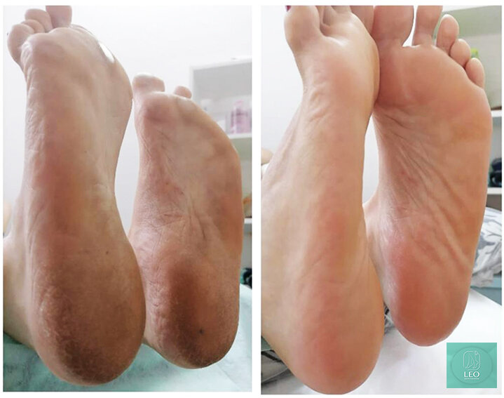 На фото результат гигиенического педикюра в нашем центре