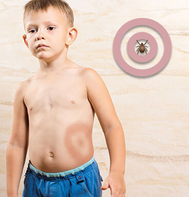 Мигрирующая эритема на теле ребенка