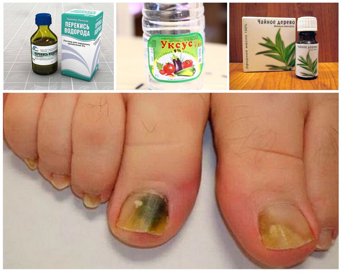 Грибок ногтей на ногах и руках — симптомы и лекарства